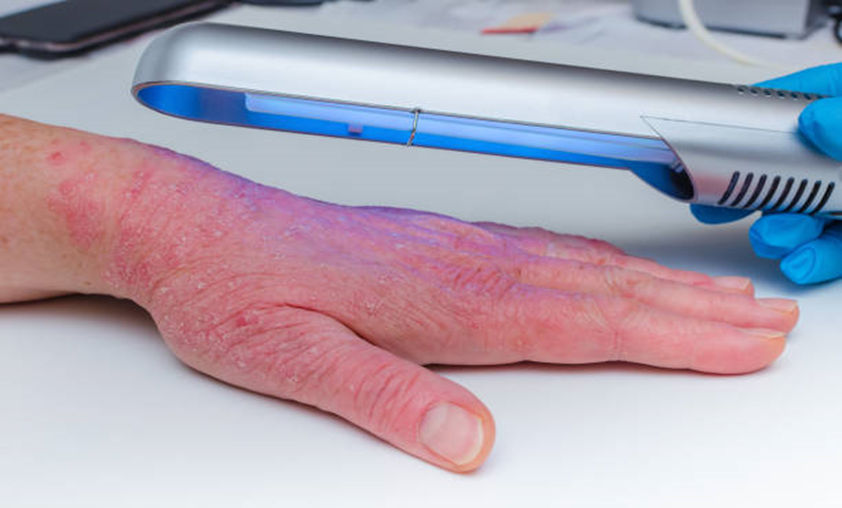 Phototherapy treatment for Psoriasis