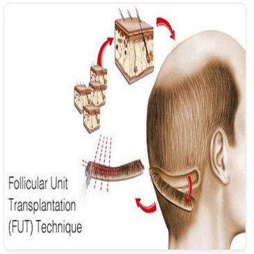 Follicular Unit Transplant (FUT)