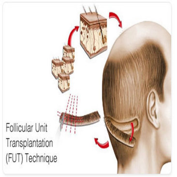 ফলিকুলার ইউনিট ট্রান্সপ্লান্ট (FUT)
