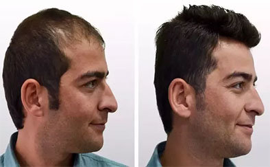 Follicular Unit Extraction