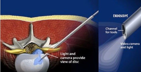 Endoscopic spine surgery