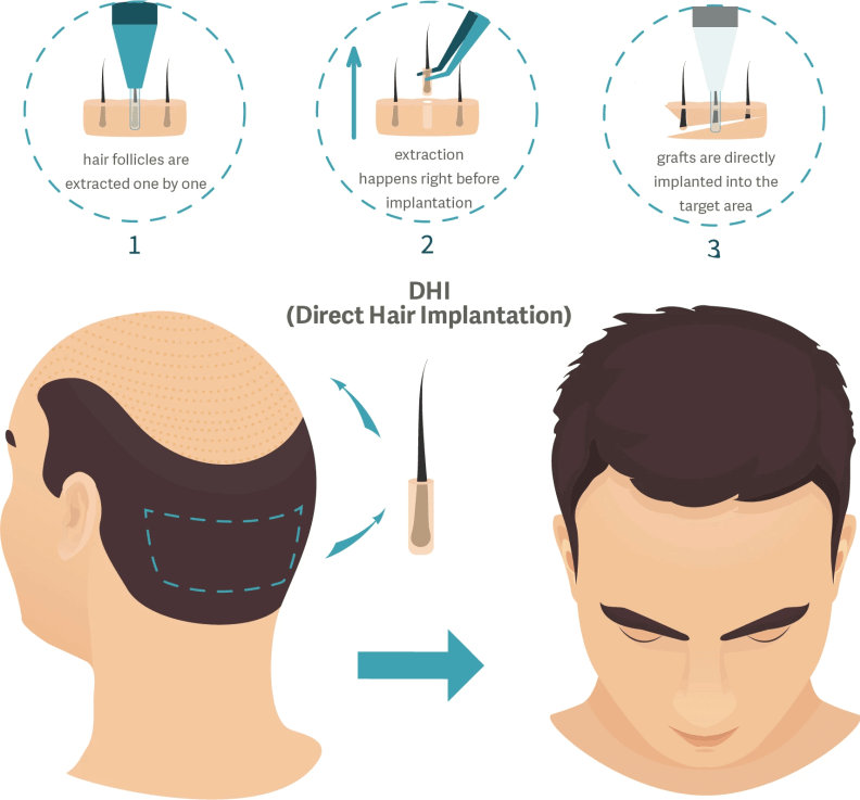 DHT (Direct Hair Transplantation)/ DHI (Direct Hair Implant) Technique used in Delhi