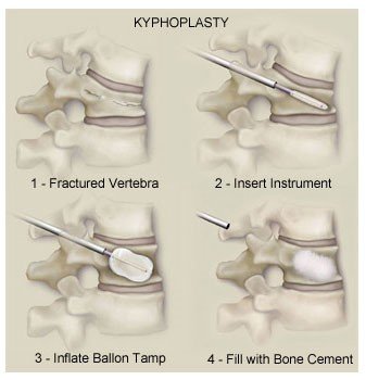 Kyphoplasty