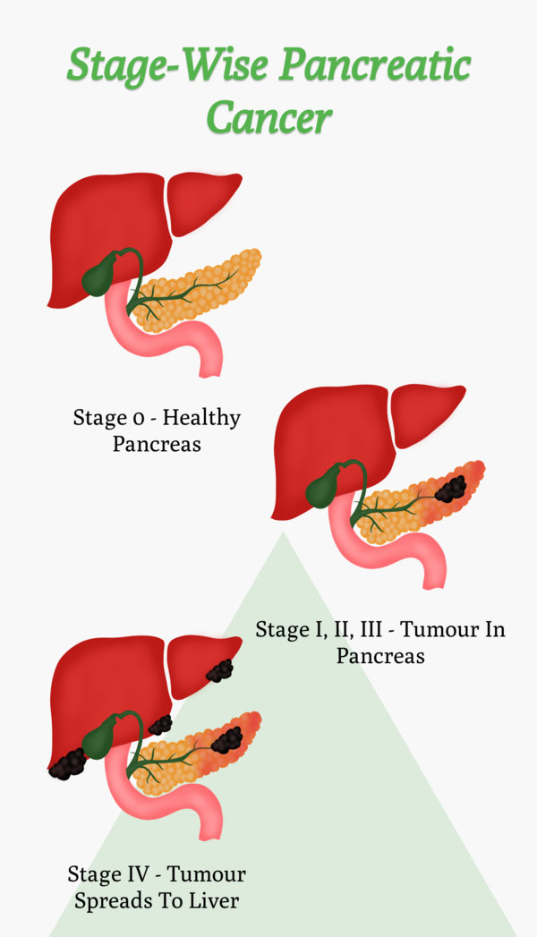 stage wise pancreatic cancer