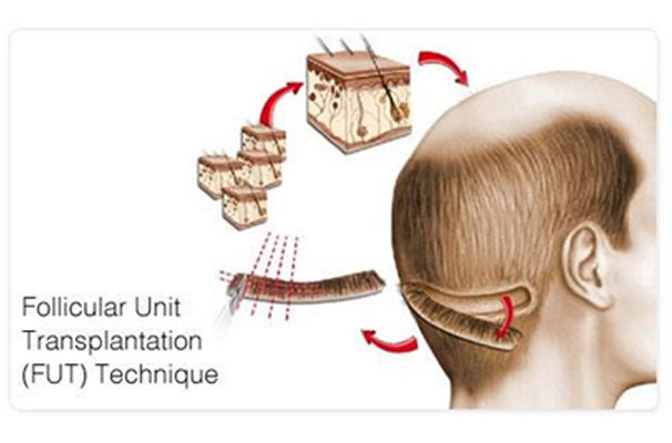 FUT treatment