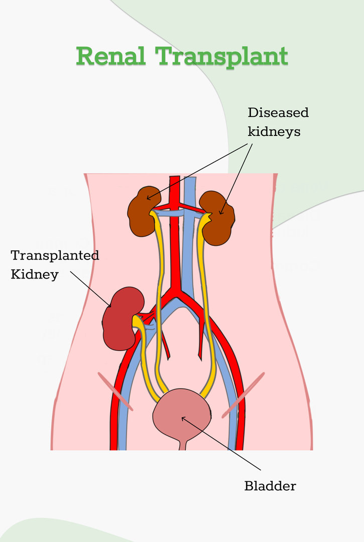 Transplantation rénale