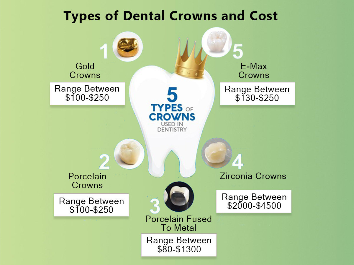 Couronne dentaire : Procédure, types et coûts expliqués en détail
