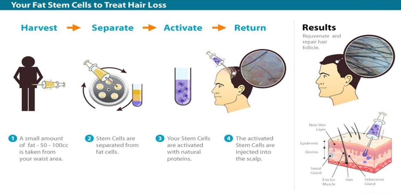 stem cell therapy cost