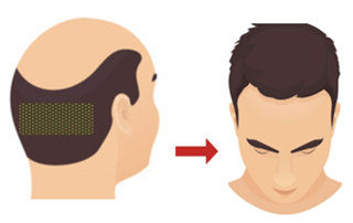 FUE hair transplant in Mumbai