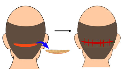 FUT hair transplant in Mumbai