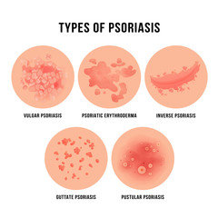 Types de psoriasis