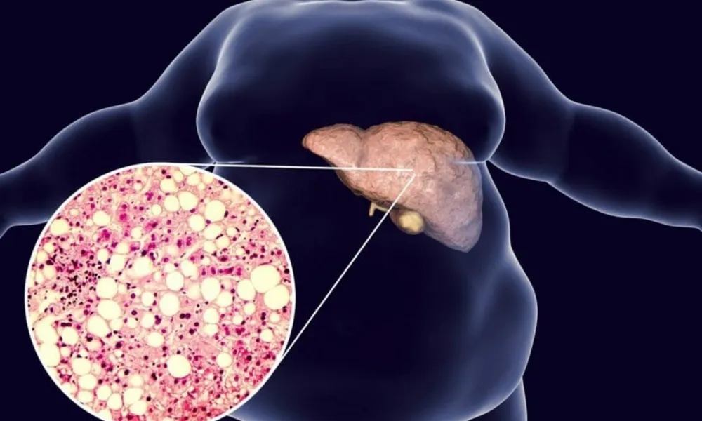 Hydroxychloroquine May Reduce Risk of Nonalcoholic Fatty Liver Disease in Rheumatoid Arthritis Patients