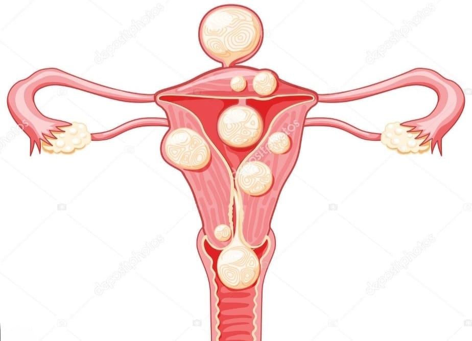 Fibroid Treatment