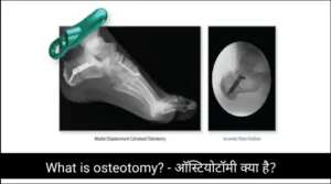 What is osteotomy? - ऑस्टियोटॉमी क्या है?