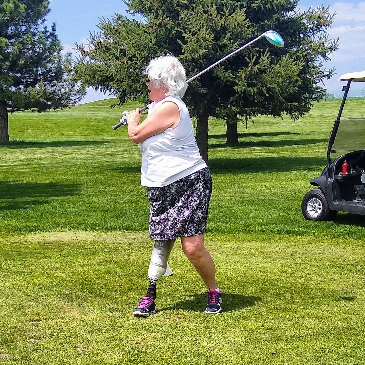 Patient golfing confidently, showing her prosthetic leg below the knee