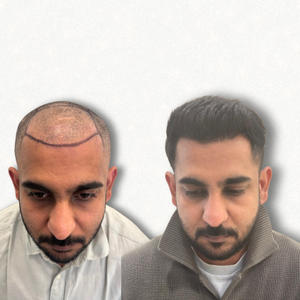 Hair Transplant Result Bangalore