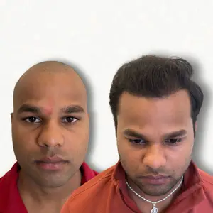 Hair Transplant Result Mumbai - Before After