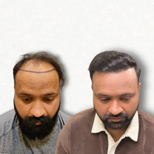 Hair Transplant Result Bangalore