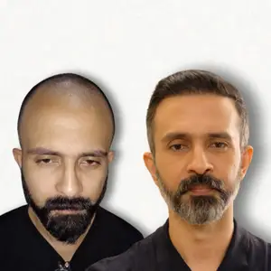 Hair Transplant Result Mumbai - Before After