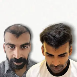 Hair Transplant Result Mumbai - Before After