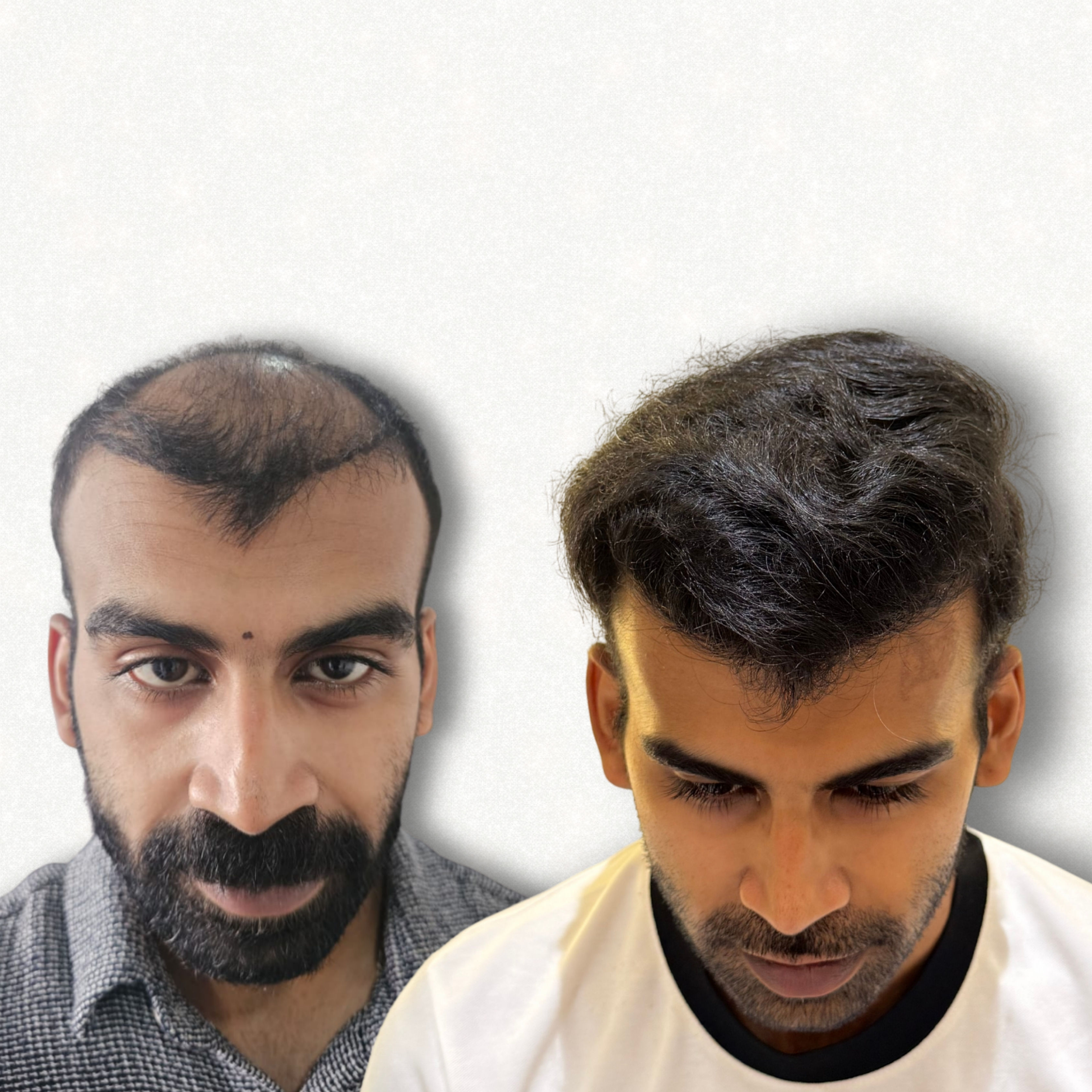 Hair Transplant Result Hyderabad