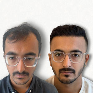 Hair Transplant Result Bangalore