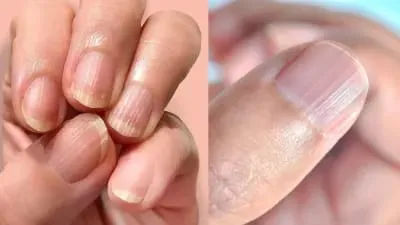 नाखूनों पर रेखाएं आना किस बात का संकेत है? जानिए शरीर में किस पोषक तत्व की कमी से होता है