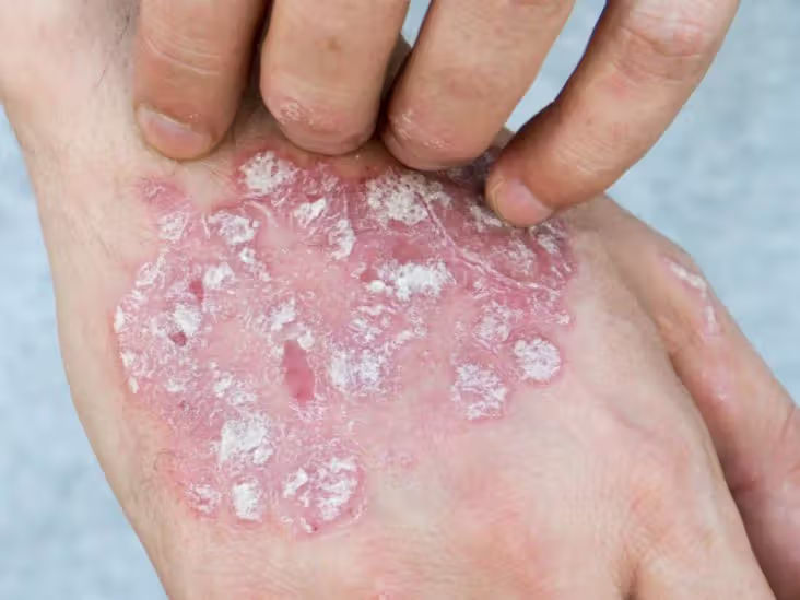 What causes inflammation in psoriasis?
