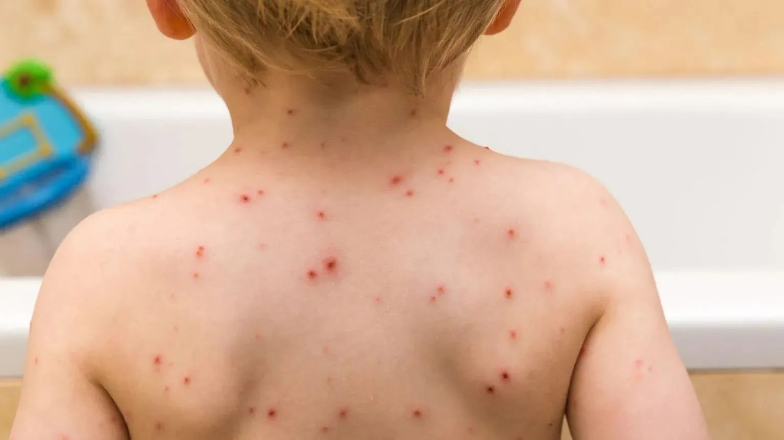 NHS to Offer Free Chickenpox Vaccine to Young Children in the UK