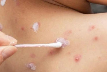 Nghệ An: Hành trình vượt qua nguy kịch của bé gái 4 tuổi mắc bệnh thuỷ đậu