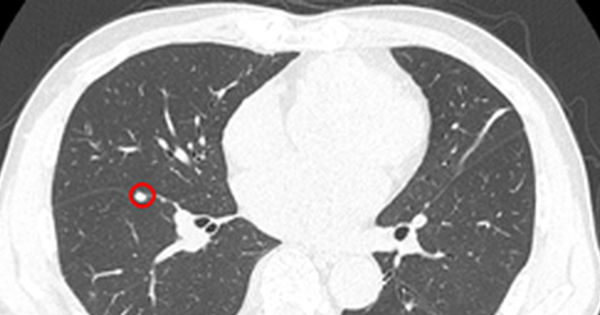 Đa Ung Thư Nguyên Phát: Bài Toán Khó của Y Học
