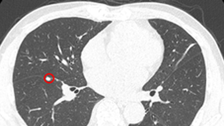 Đa Ung Thư Nguyên Phát: Bài Toán Khó của Y Học
