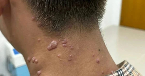 Hành Trình Điều Trị Bệnh Đậu Mùa Khỉ ở Đồng Nai