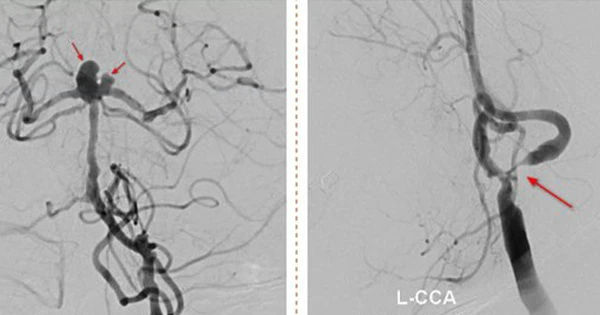 Đột quỵ đặc biệt nguy hiểm: Cuộc chiến với nhồi máu não và nguy cơ vỡ túi phình