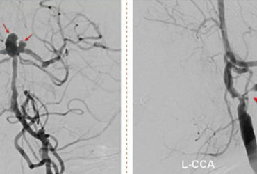Đột quỵ đặc biệt nguy hiểm: Cuộc chiến với nhồi máu não và nguy cơ vỡ túi phình