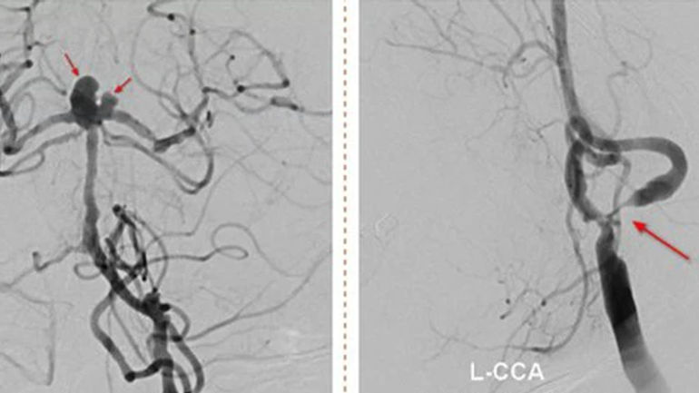 Đột quỵ đặc biệt nguy hiểm: Cuộc chiến với nhồi máu não và nguy cơ vỡ túi phình