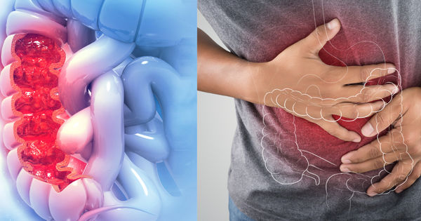 Những Bí Mật Để Bảo Vệ Đại Tràng Khỏi Ung Thư