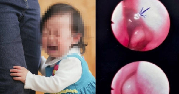 Bí mật kinh hoàng trong lỗ mũi của bé gái 13 tháng tuổi ở Bình Thuận
