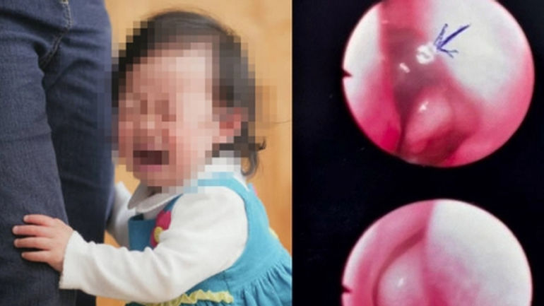 Bí mật kinh hoàng trong lỗ mũi của bé gái 13 tháng tuổi ở Bình Thuận