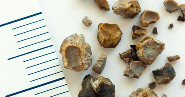 Khám phá 9 vị trí bí ẩn trong cơ thể có thể 'mọc sỏi' và cách nhận biết triệu chứng