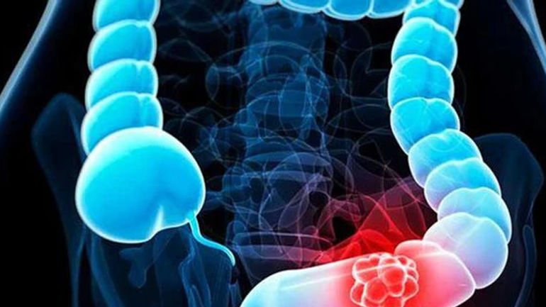 Những Dấu Hiệu Nhỏ Có Thể Cảnh Báo Ung Thư: Hãy Chú Ý!