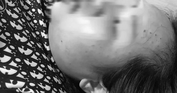 Sự kỳ quặc khi bị tiêm nhầm sữa rửa mặt vào da