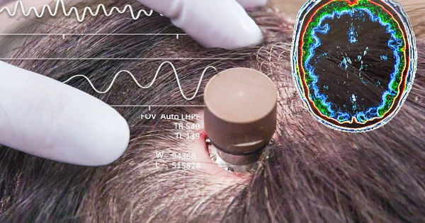 Sức Mạnh của Công Nghệ: Chơi Game chỉ Bằng Tín Hiệu Não với Neuralink