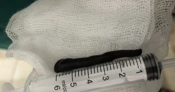 Khám phá một con giun đỉa dài 6cm trong khí quản người đàn ông