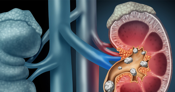 Khám phá những thói quen gây túi sỏi thận mà bạn chưa hề biết