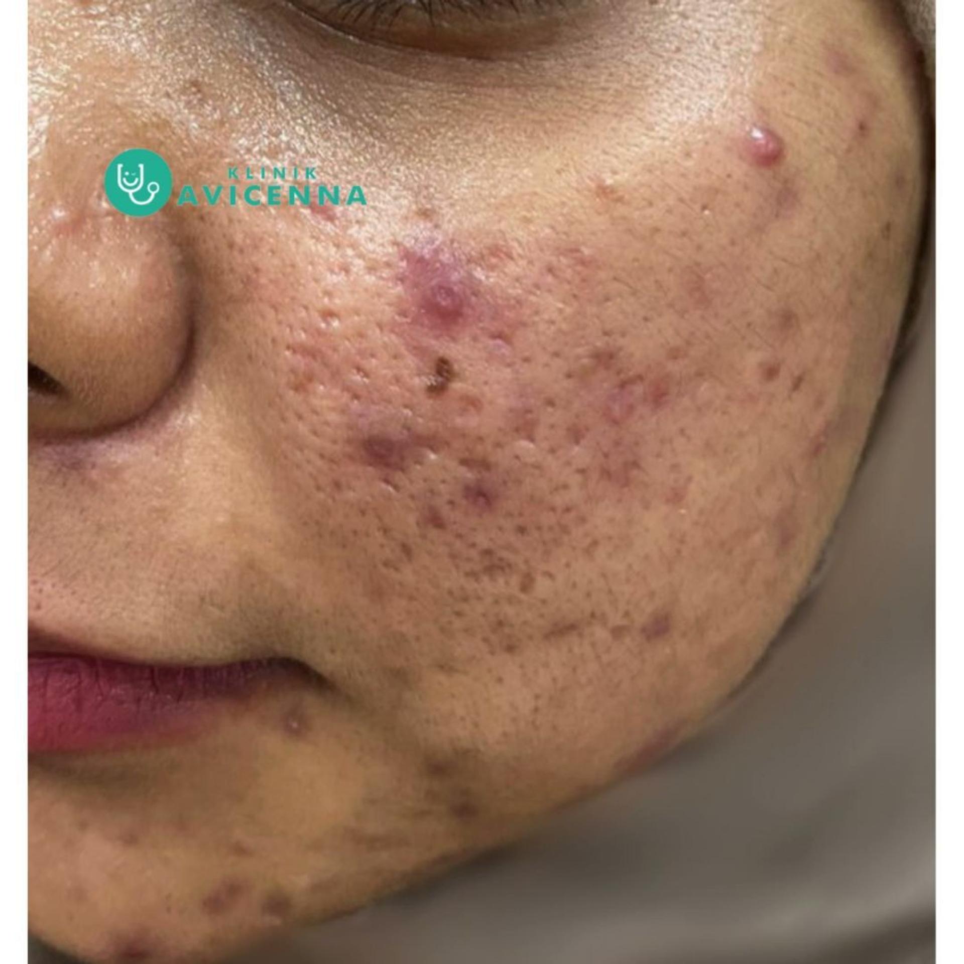 Photo 6 for Avicenna Laser & Aesthetic Centre Bangi