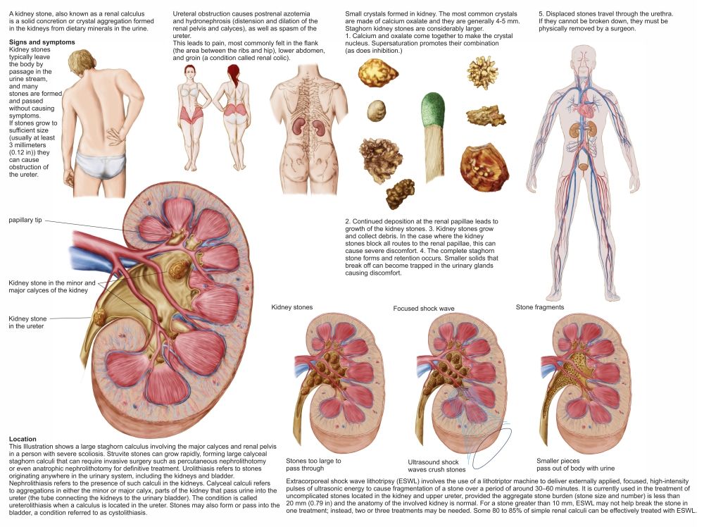 StockTrek Images PSTSTK701049H Medical Chart Showing The Signs & Symptoms of Kidney Stones Poster Print&#44; 16 x 12