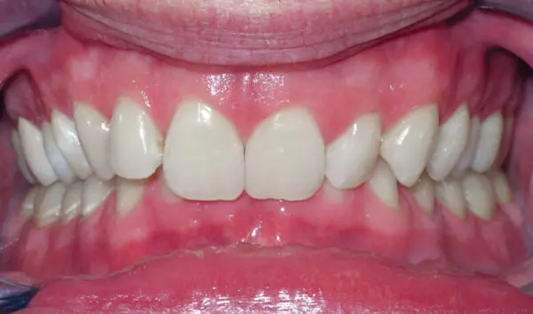 Patient with an overbite