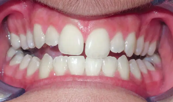 Patient with an openbite