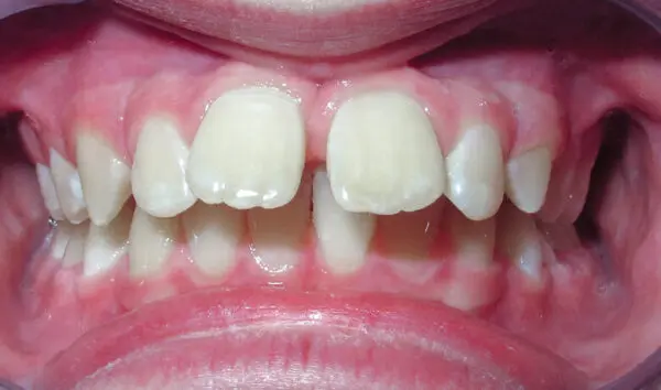 Patient with an overbite, spacing and protrusion